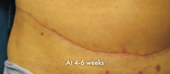Panniculectomy scar at 4-6 weeks