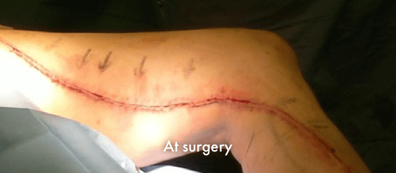 Femoral Popliteal Bypass at time of surgery, using INSORB Skin Stapler