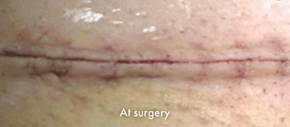 C-section incision at time of surgery