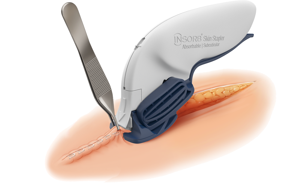 INSORB Skin Stapler being used to close an incision