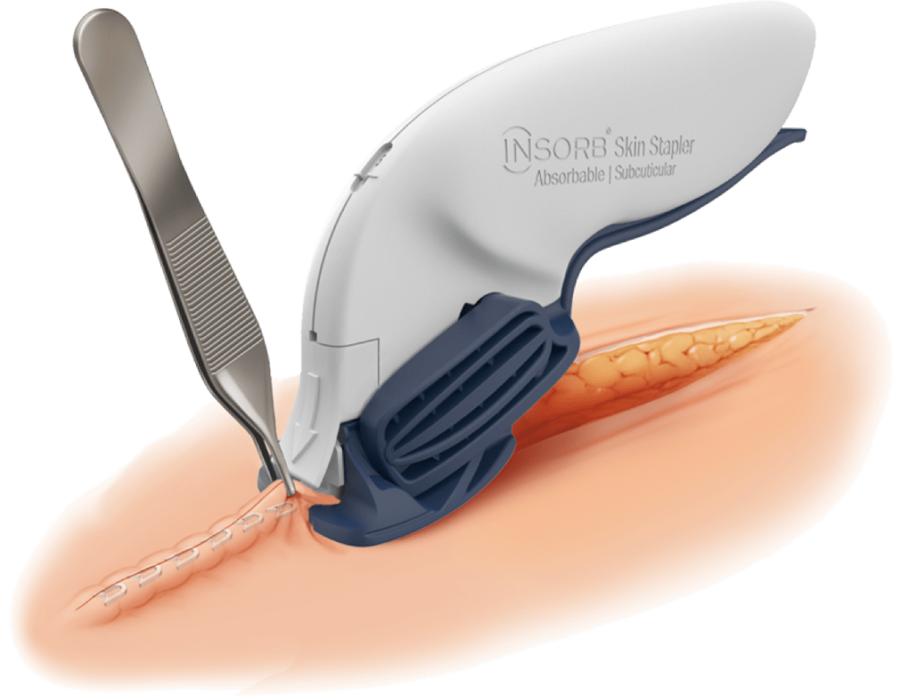 INSORB Skin Stapler being used to close and staple a surgical incision