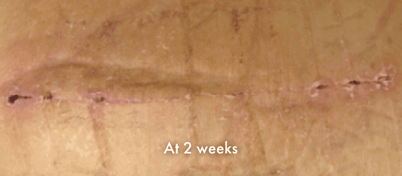 Total Hip Arthroplasty scar at 2 weeks after surgery, incision closed with INSORB Skin Stapler