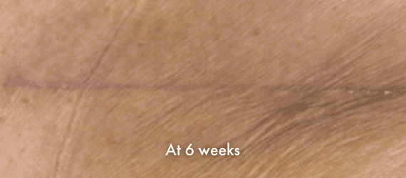 Total Hip Arthroplasty scar at 6 weeks, using INSORB skin stapler