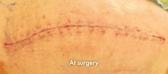 Total Knee Arthroplasty at time of surgery, incision closed with INSORB Skin Stapler