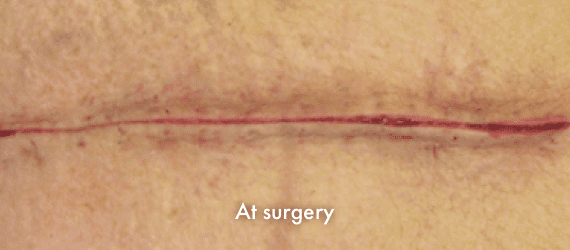 Total Hip Arthroplasty incision at surgery, closed with INSORB Skin Stapler