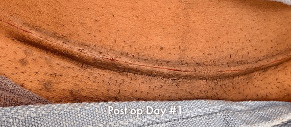 C-section Post op scar, day #1 after surgery, using INSORB Skin Stapler