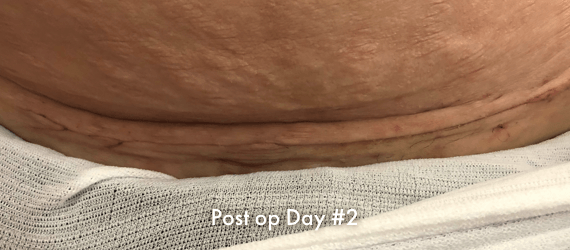 C-section Post op Day #2, incision closed with INSORB Skin Stapler