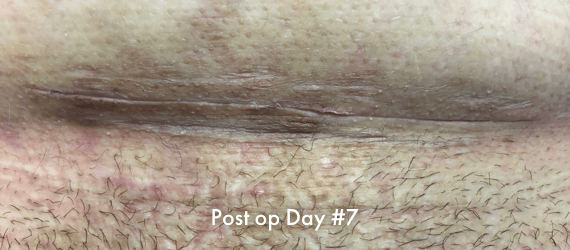 C-section Post op scar Day #7, following surgery and closed with INSORB Skin Stapler