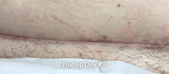 C-section Post op scar Day#8, after surgery using INSORB Skin Stapler to close incision