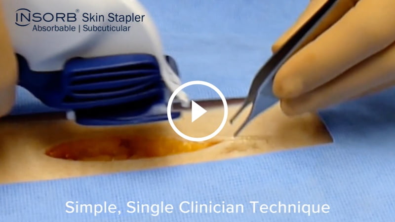 Surgical Incision Closing Comparison Video